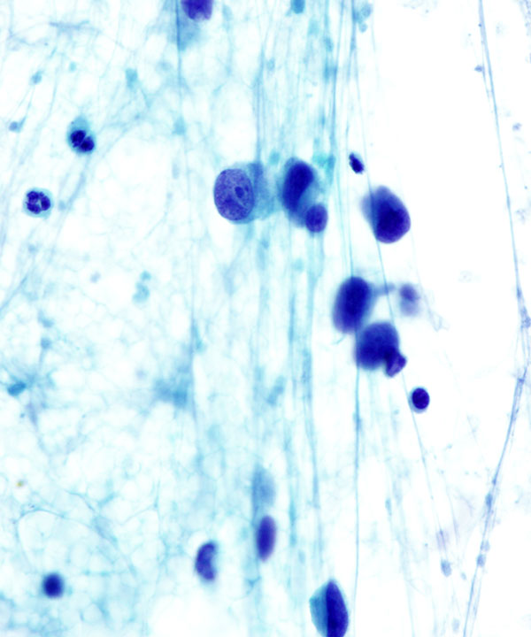 4 : Breast Lobular Carcinoma
