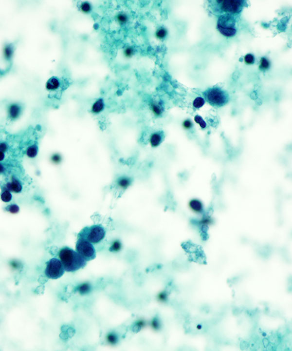 5 : Breast Lobular Carcinoma