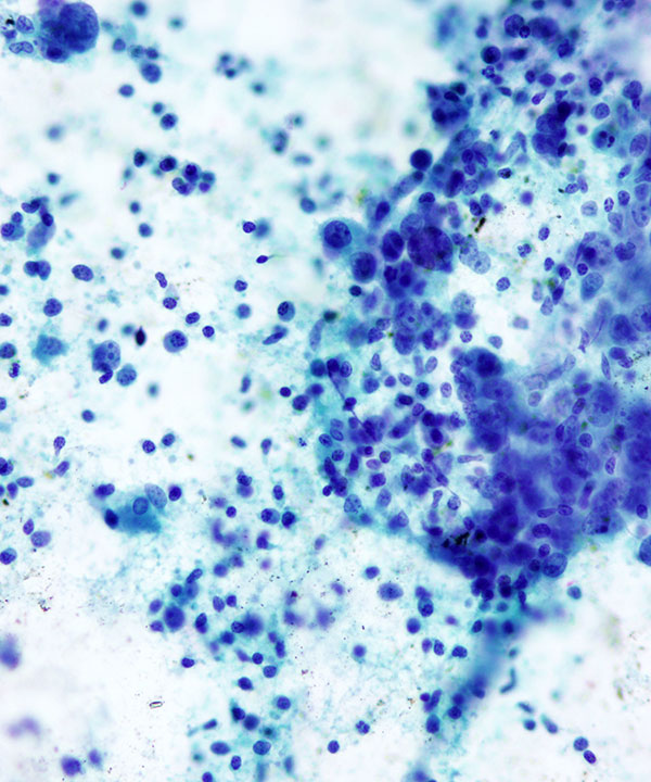 image showing 'Medullary Carcinoma'