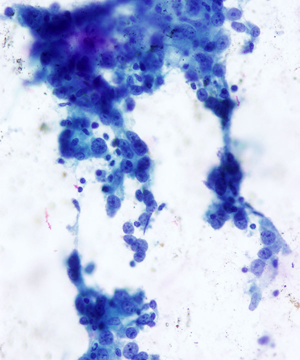 2 : Breast Medullary Carcinoma