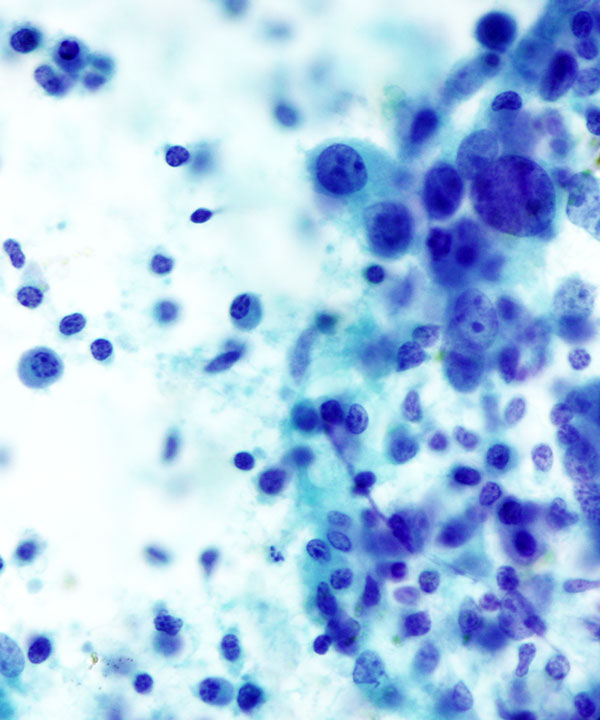 3 : Breast Medullary Carcinoma