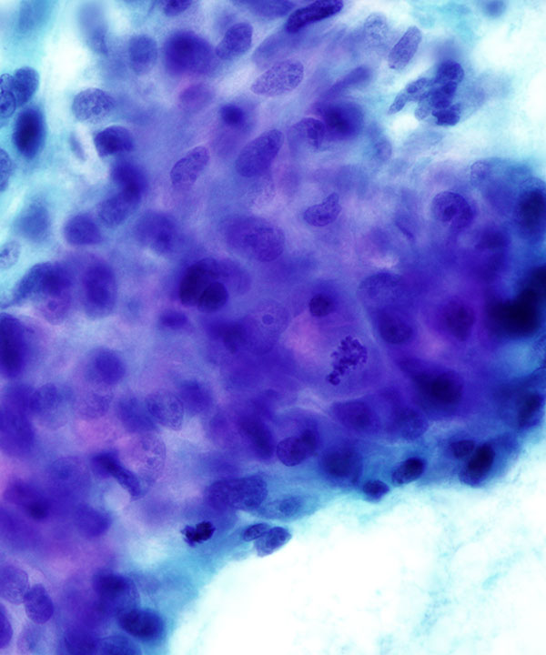 2 : Breast Metaplastic Carcinoma