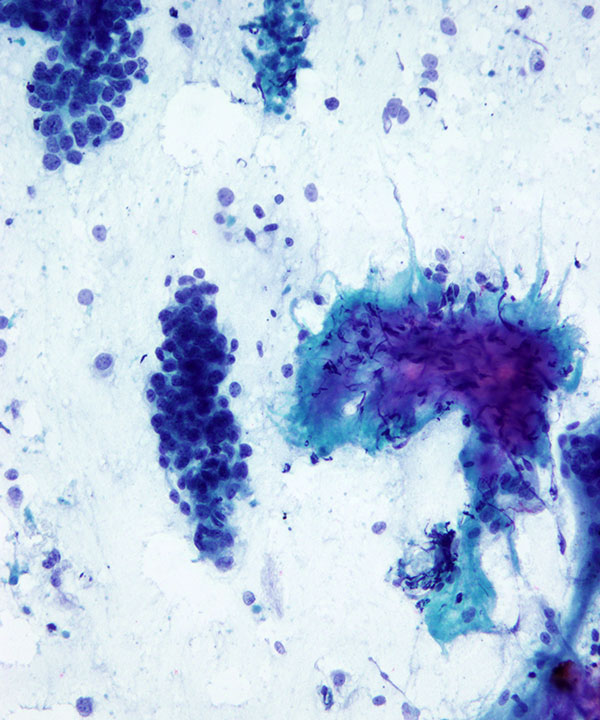 3 : Breast Metaplastic Carcinoma