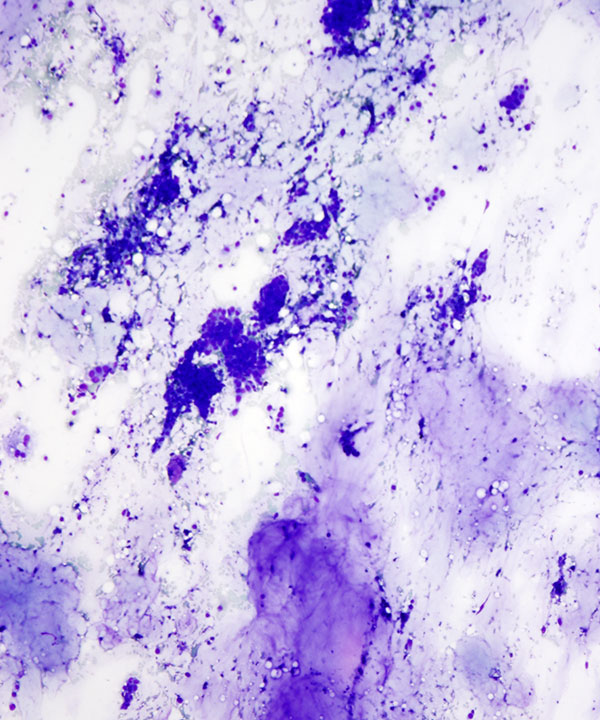 image showing 'Mucinous Carcinoma'