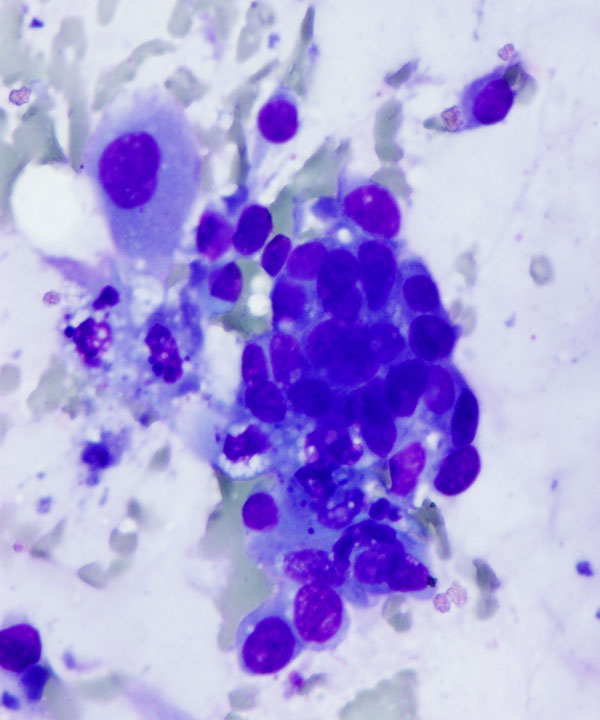 02 : Breast Mucinous Carcinoma