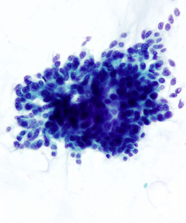 04 : Breast Mucinous Carcinoma