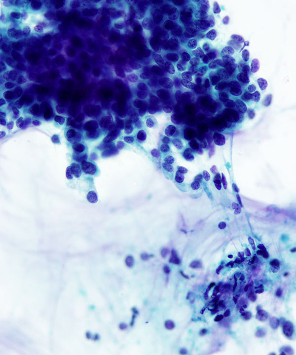 05 : Breast Mucinous Carcinoma