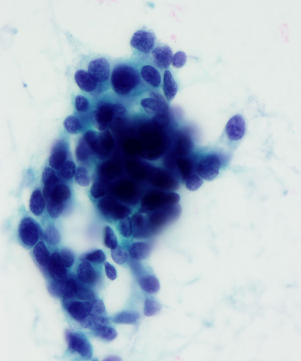 06 : Breast Mucinous Carcinoma