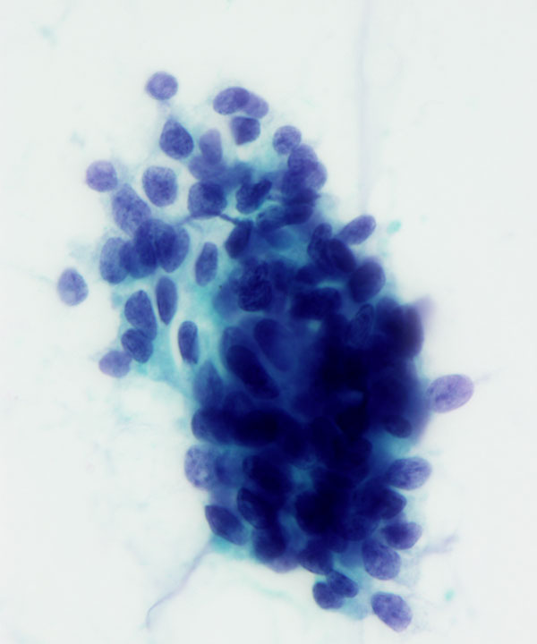 07 : Breast Mucinous Carcinoma