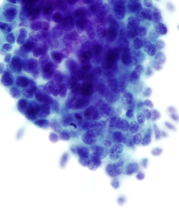 08 : Breast Mucinous Carcinoma