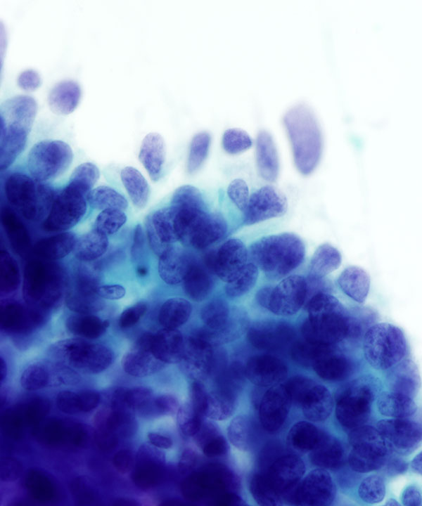 09 : Breast Mucinous Carcinoma