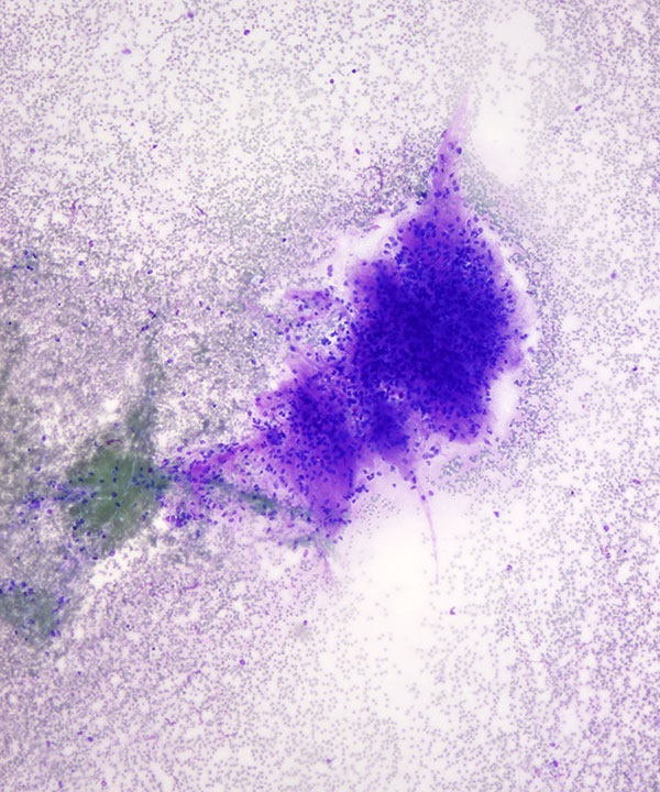 01 : Breast Phyllodes Tumor