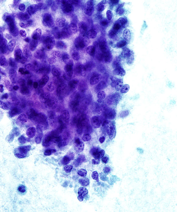 05 : Breast Phyllodes Tumor