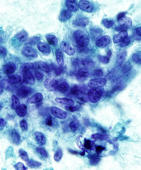 06 : Breast Phyllodes Tumor