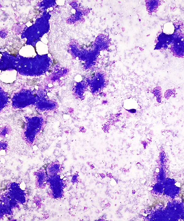 image showing 'Tubular Carcinoma'