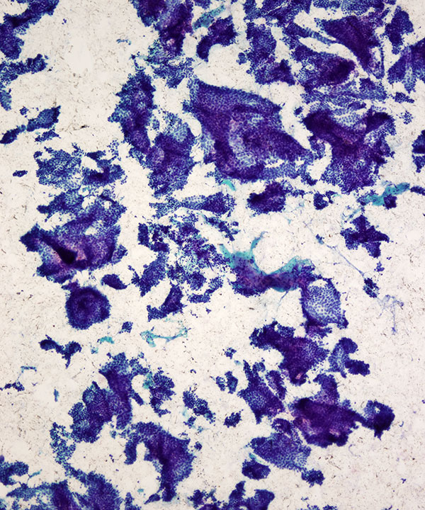 02 : Breast Tubular Carcinoma