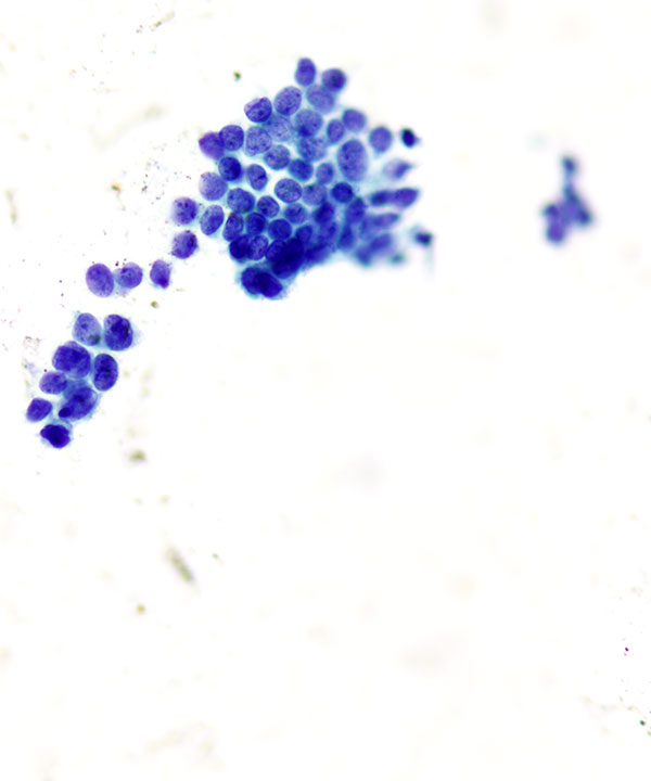 04 : Breast Tubular Carcinoma