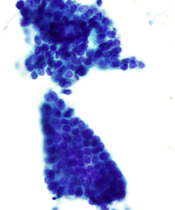 05 : Breast Tubular Carcinoma