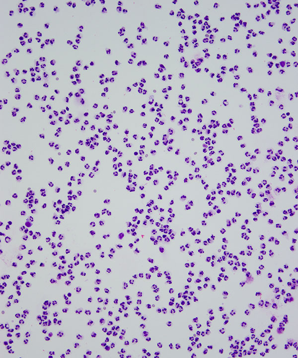 image showing 'CSF Acute inflammation'