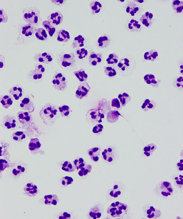 02 : CSF Acute inflammation