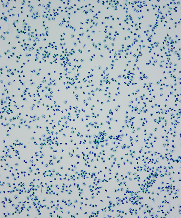 03 : CSF Acute inflammation