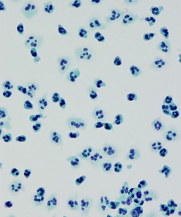 04 : CSF Acute inflammation