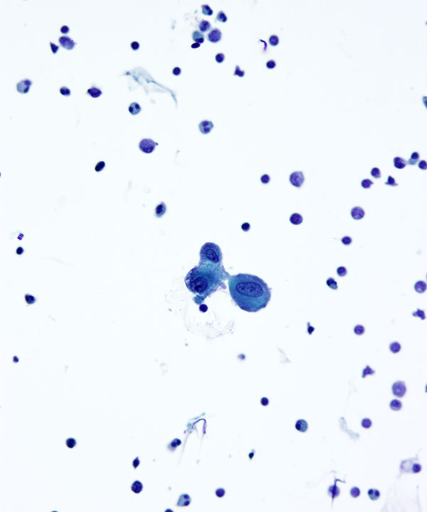 image showing 'CSF Ependymoma'