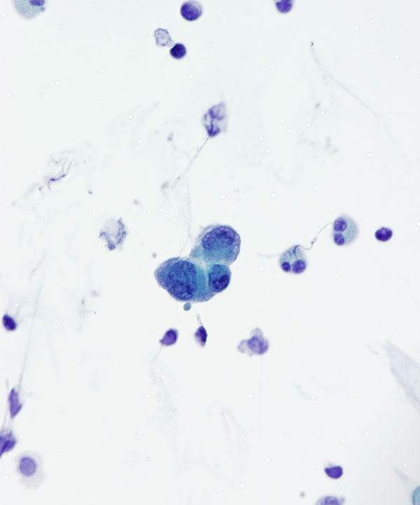 02 : CSF Ependymoma