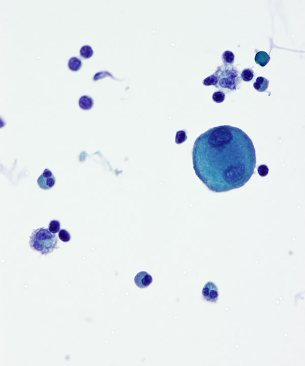 03 : CSF Ependymoma