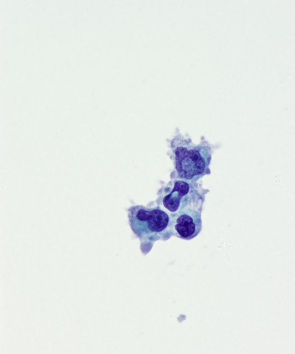 02 : CSF Glioblastoma