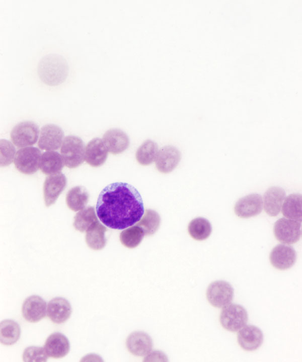 02 : CSF Leukemia
