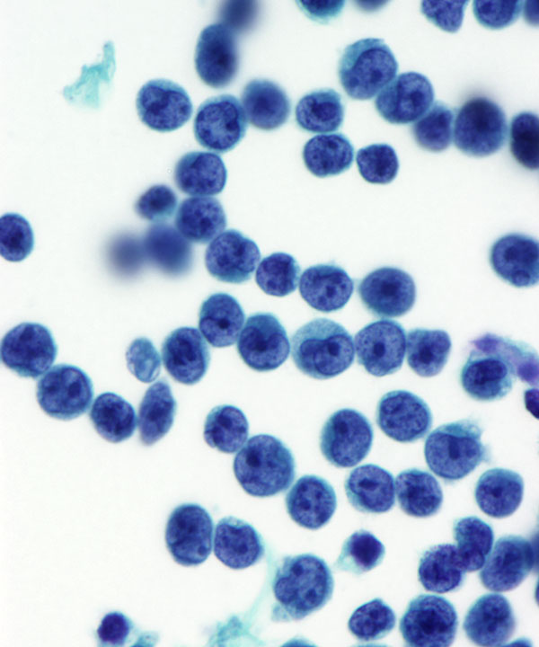 03 : CSF Leukemia