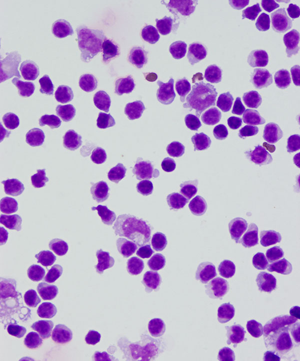 02 : CSF Lymphocytosis