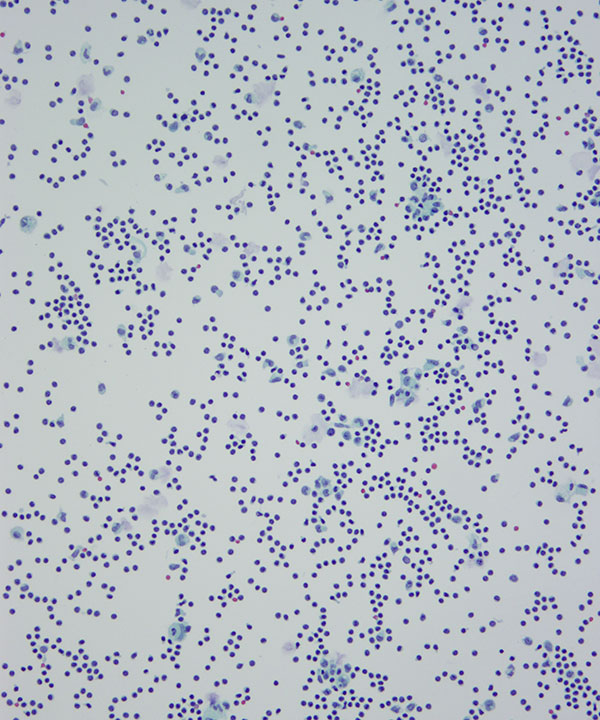 03 : CSF Lymphocytosis