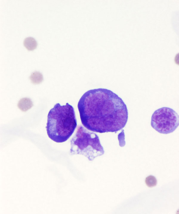 02 : CSF Lymphoma