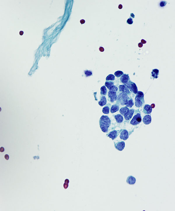 02 : CSF Medulloblastoma