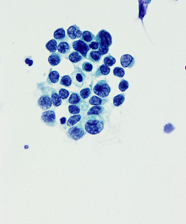 03 : CSF Medulloblastoma