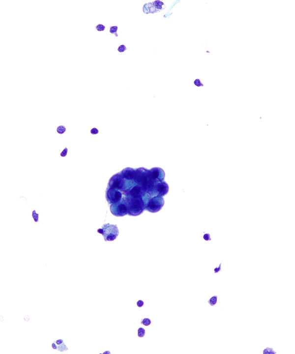 image showing 'CSF Metastatic Breast Carcinoma'