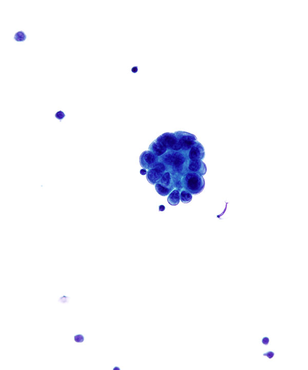 02 : CSF Metastatic Breast Carcinoma