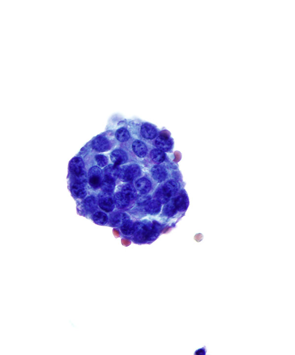 03 : CSF Metastatic Breast Carcinoma