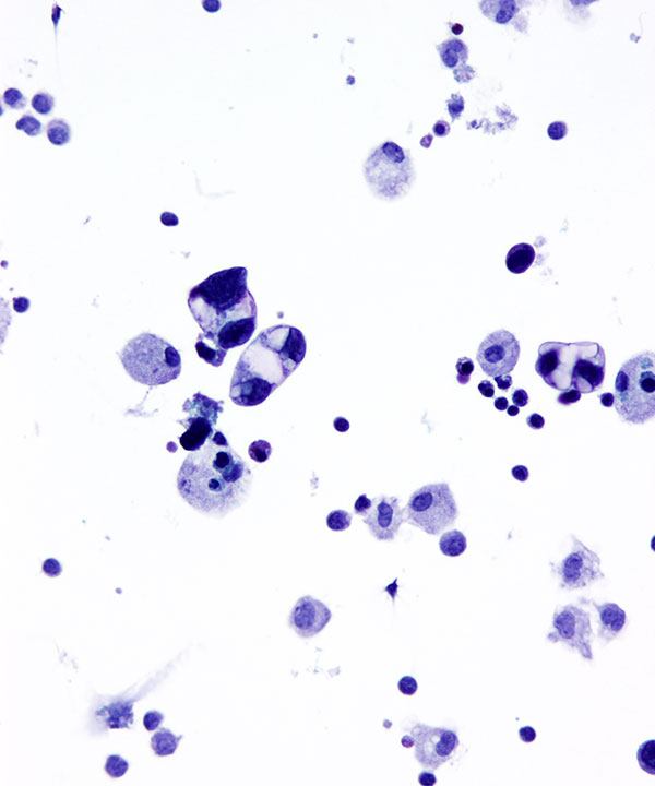 image showing 'CSF Metastatic Lung Carcinoma'