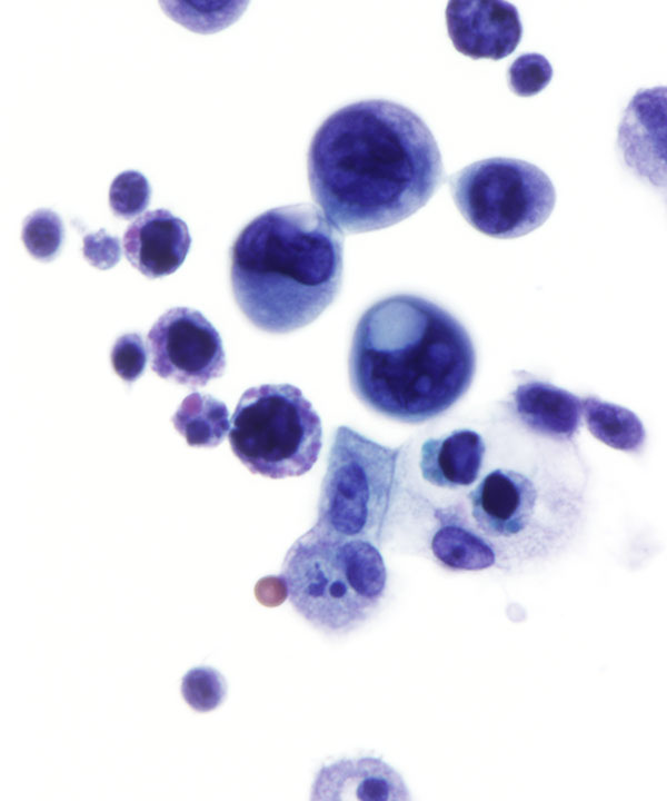 02 : CSF Metastatic Lung Carcinoma