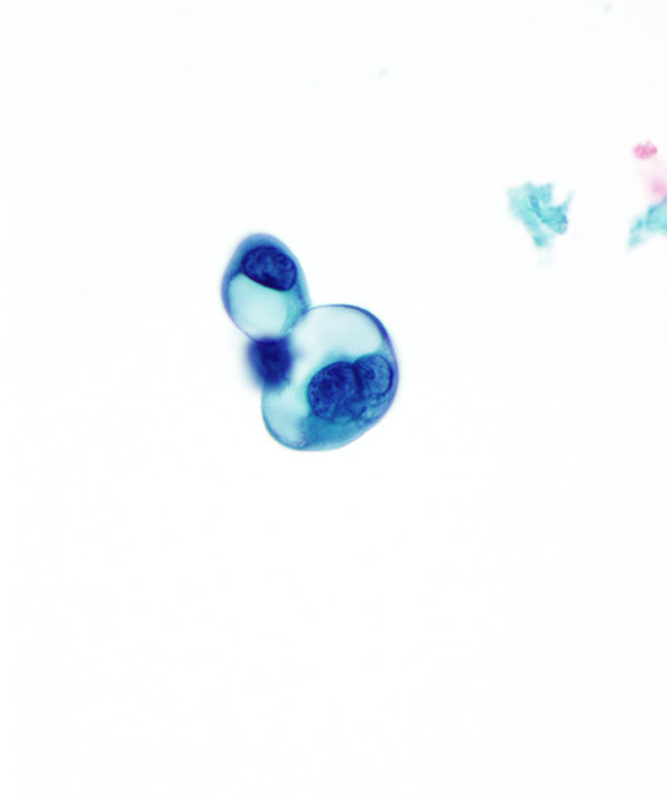 03 : CSF Metastatic Lung Carcinoma