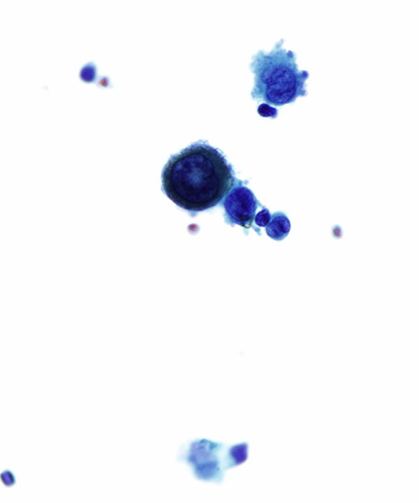 03 : CSF Metastatic Melanoma