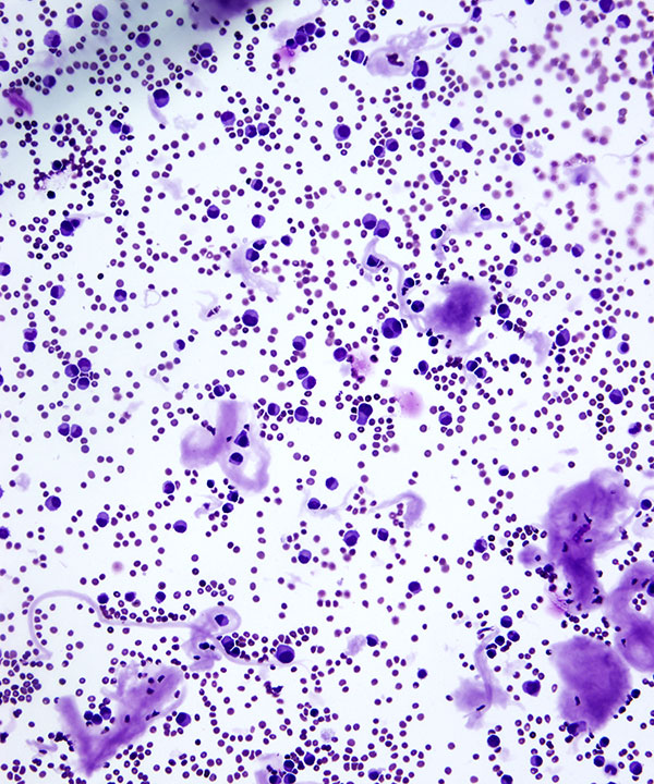 image showing 'CSF Myeloma'