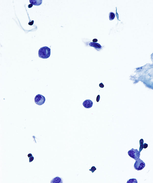 03 : CSF Myeloma