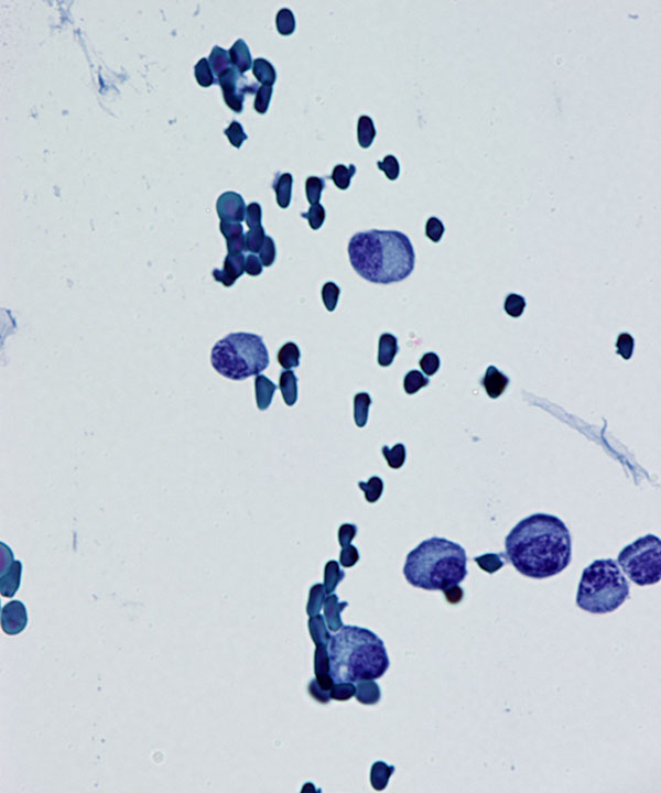 04 : CSF Myeloma