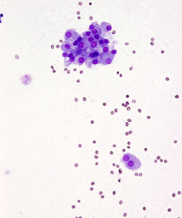 image showing 'Chronic Lymphocytic Thyroiditis'