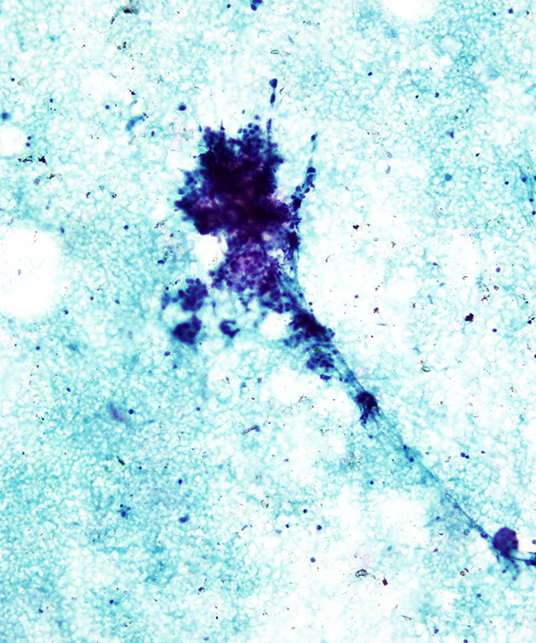02 : Chronic Lymphocytic Thyroiditis