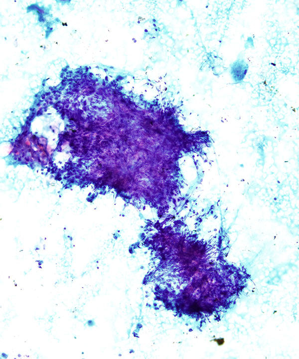 03 : Chronic Lymphocytic Thyroiditis